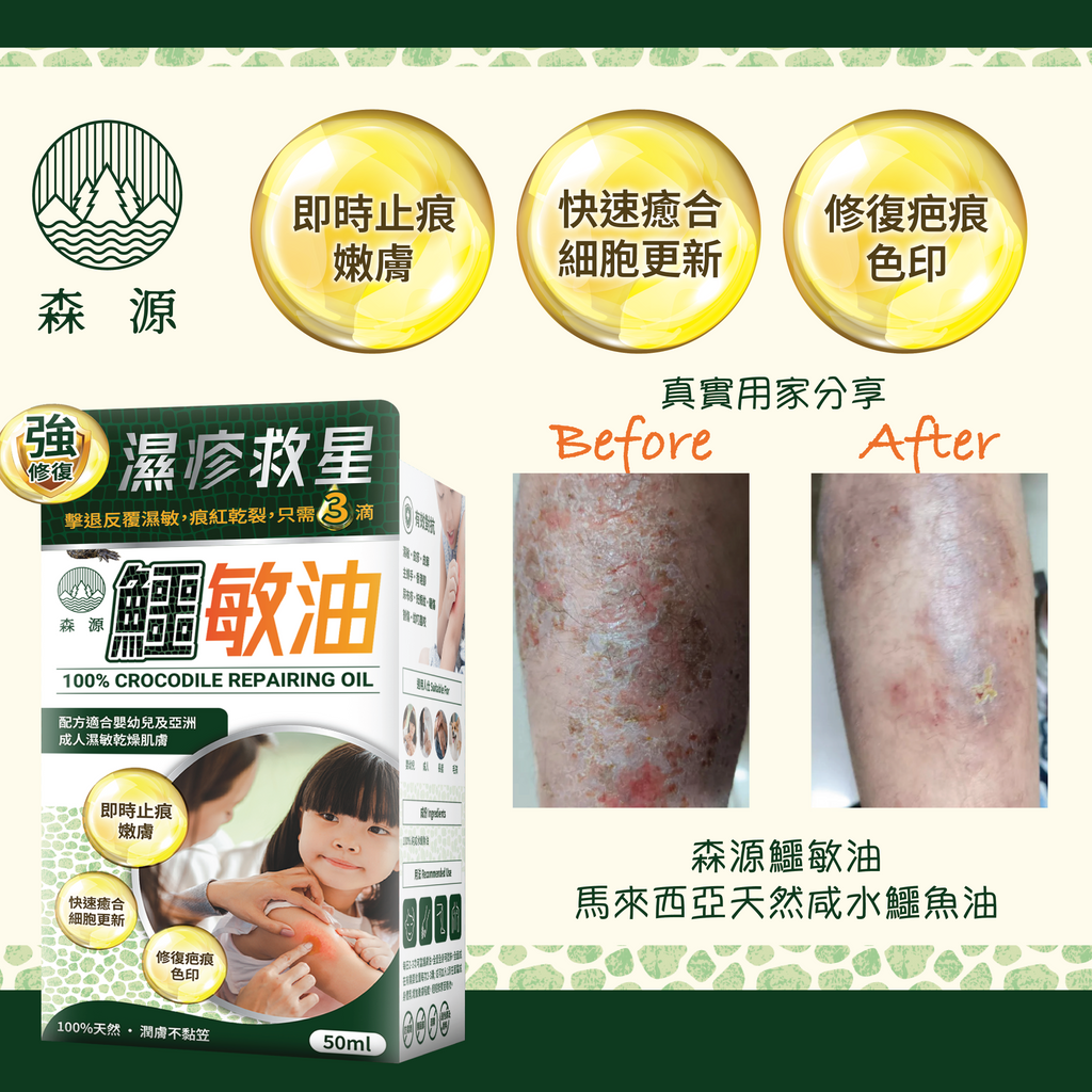 森源 -【濕疹敏感救星】100%天然無類固醇強修復鱷敏油 (50毫升)