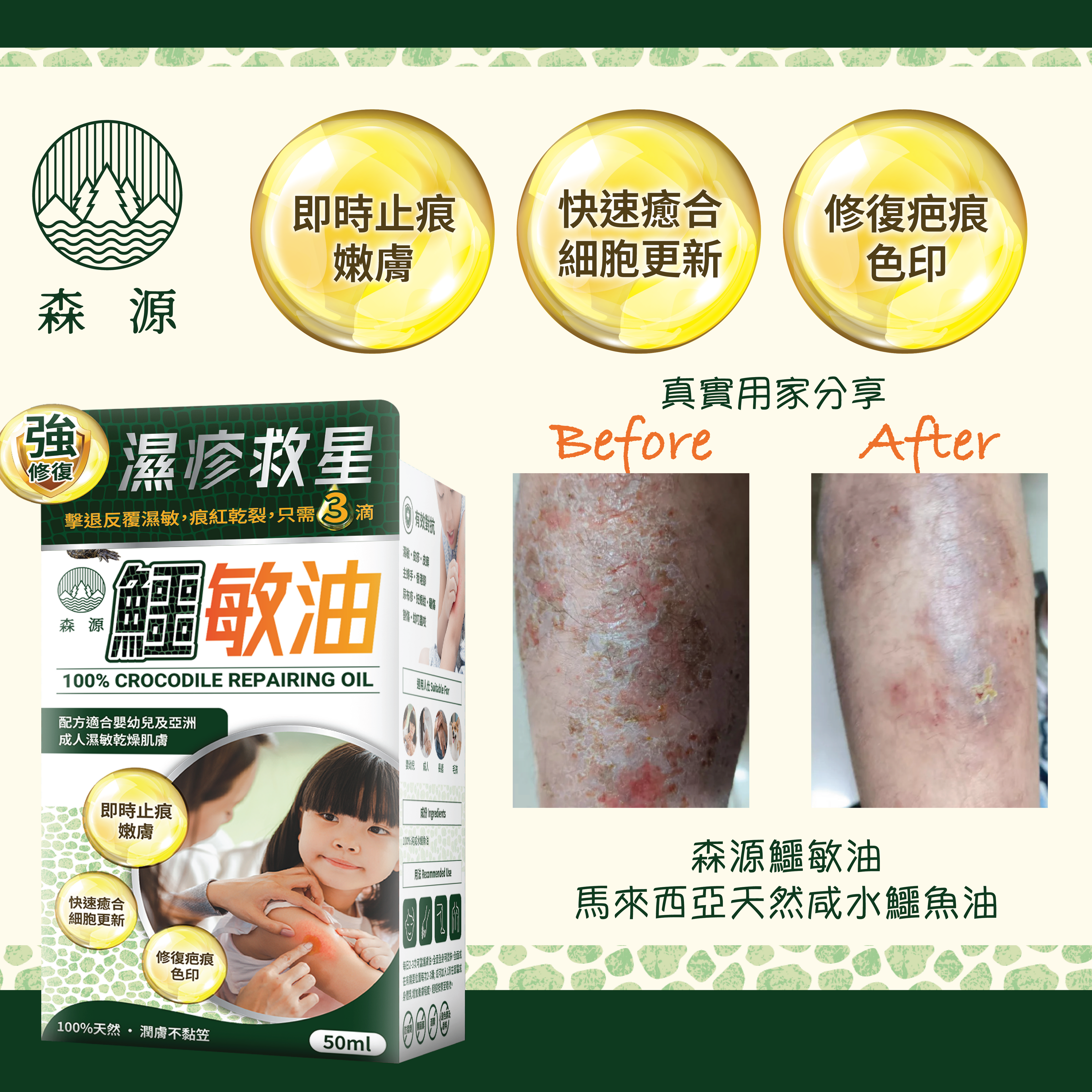 森源 -【濕疹敏感救星】100%天然無類固醇強修復鱷敏油 (50毫升)