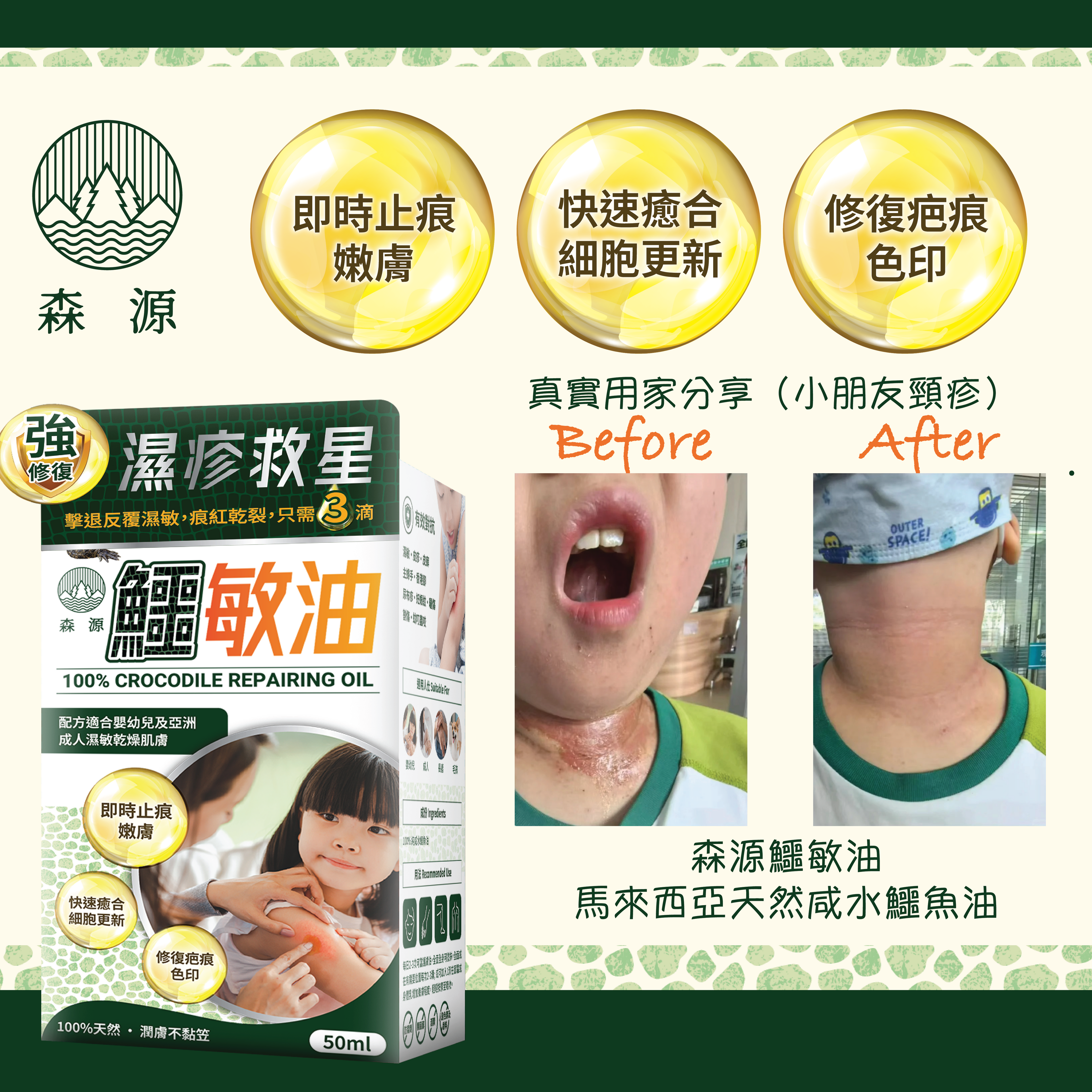 森源 -【濕疹敏感救星】100%天然無類固醇強修復鱷敏油 (50毫升)