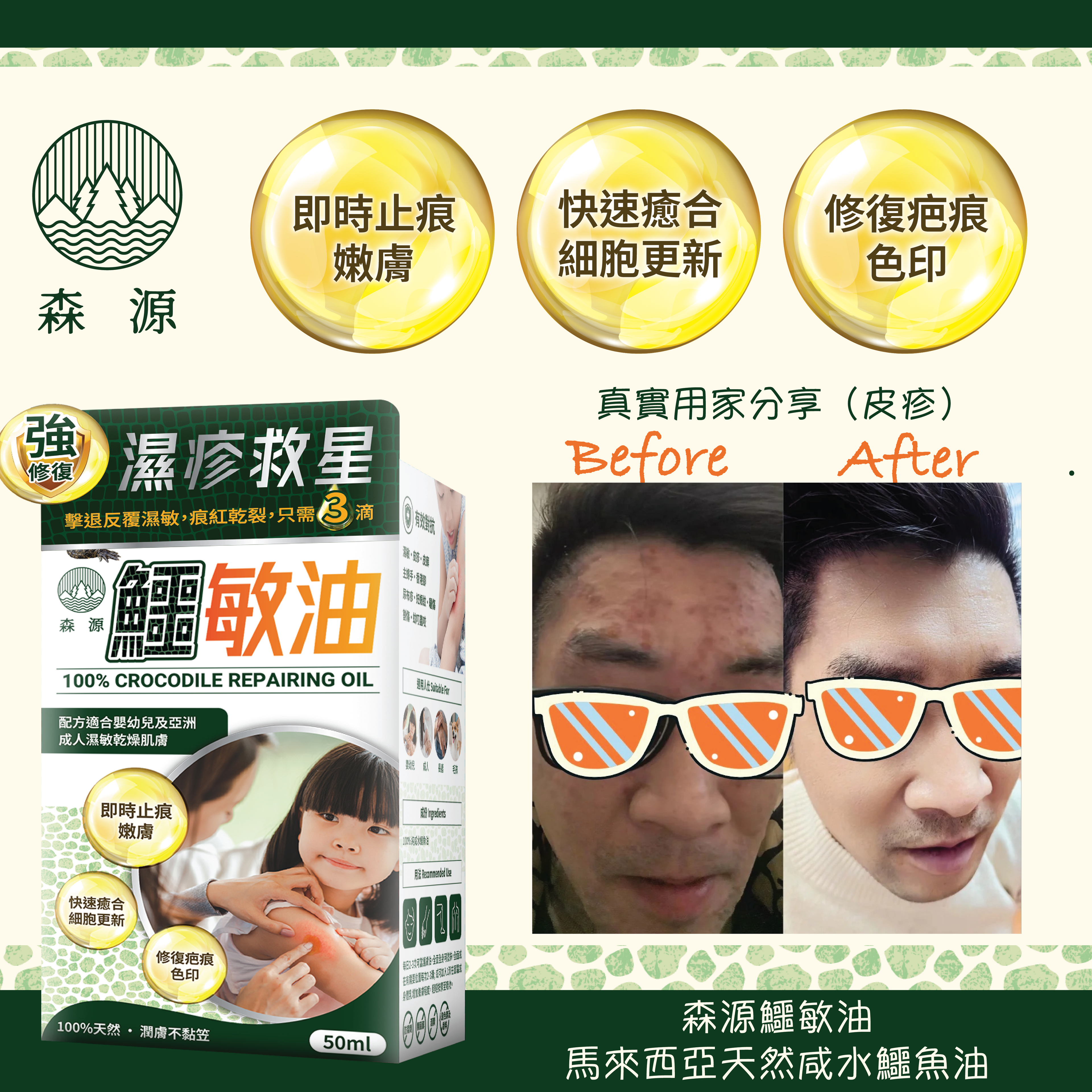 森源 -【濕疹敏感救星】100%天然無類固醇強修復鱷敏油 (50毫升)