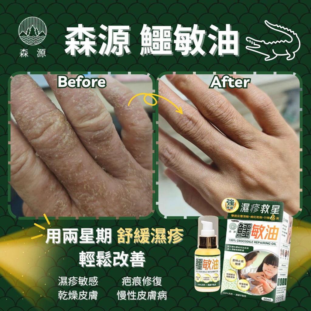 森源 -【濕疹敏感救星】100%天然無類固醇強修復鱷敏油 (50毫升)
